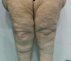 lipoedeme photo jambes