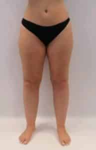 lipoedeme photo jambes lipoedeme photo jambes