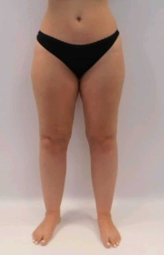 lipoedeme photo jambes