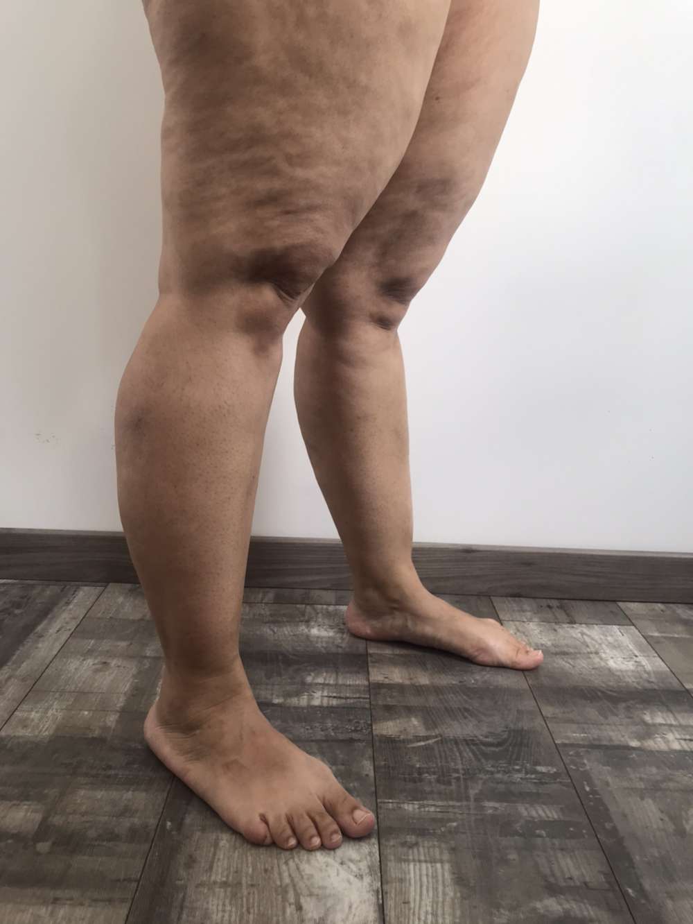 lipoedeme photo jambes