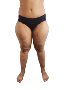 Sans titre lipoedeme des cuisses